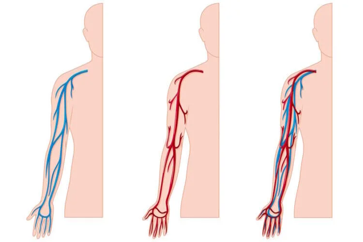 Spider Varicose Veins